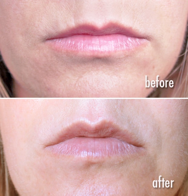 blue-medi-spa-juvederm-resultaten