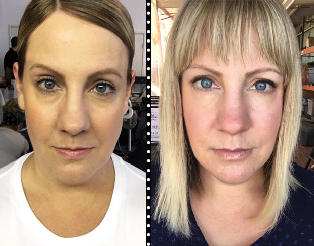 restylane-injecteerbare-resultaten-voor-na-foto's